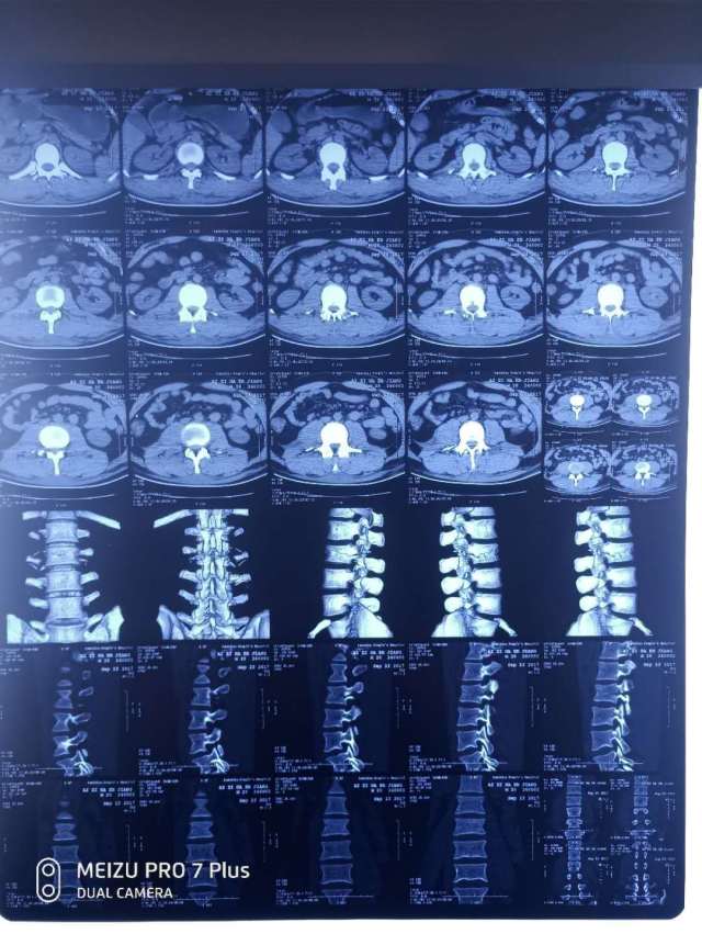 高处后隐匿性的脊柱chance骨折介绍 (原创)