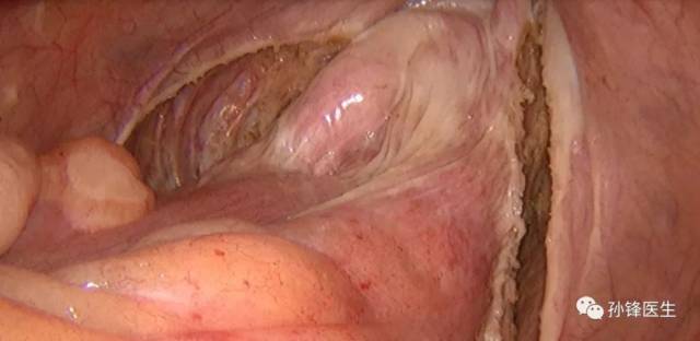 手术笔记|详细版:腹腔镜下直肠后悬吊补片固定术(图文)