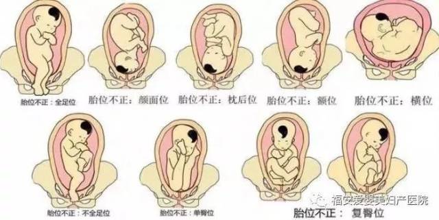 胎儿头位仰卧位图片图片