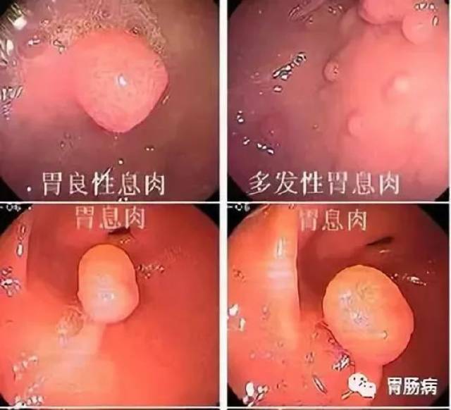 关于胃息肉,这是一篇最全面的科普_手机搜狐网