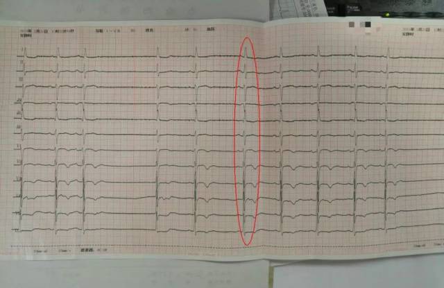 心血管内科二病区成功实施医院首例希氏束起搏术