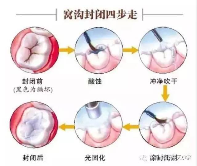 2019年東莞市二年級學生免費窩溝封閉來啦!趕緊來看看!