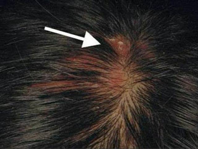 浅部真菌病:头癣,脚气,灰指甲,反复发作,用啥药效果比较好?