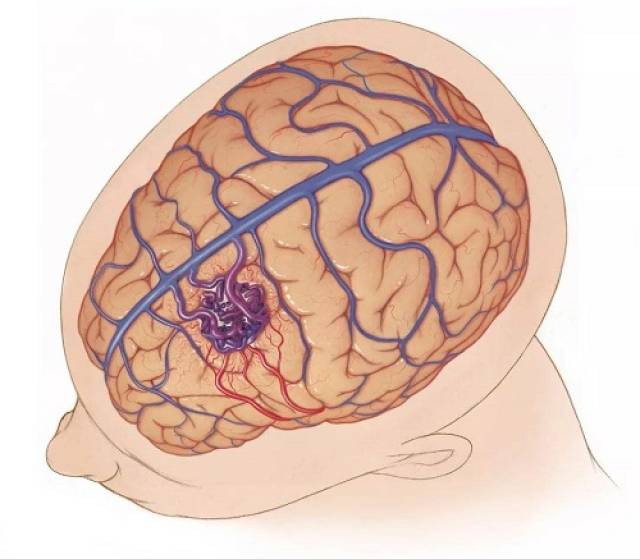 先天性脑血管畸形图片图片