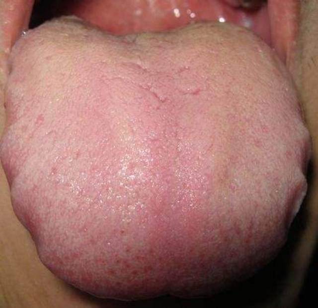 舌苔上有一层白膜一样的东西,并且舌头的边缘出现象锯齿一样的裙边舌