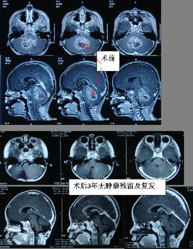 胶质瘤的诊断,治疗,预后,复查 (原创)