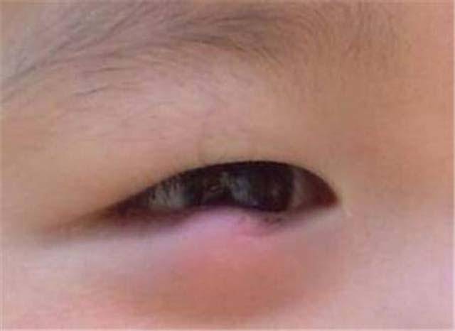 【视状元视力保健】眼睛长针眼是怎么回事?