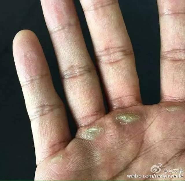 撸铁撸到手起了厚厚的老茧.