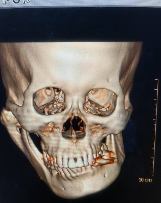 一例髁突肿瘤导致的下颌严重偏斜的手术治疗 (原创)