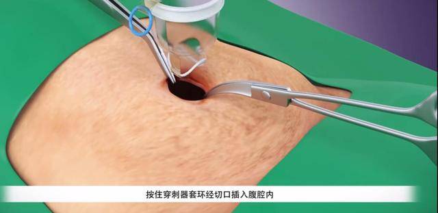 经脐无痕保胆取石术好不好