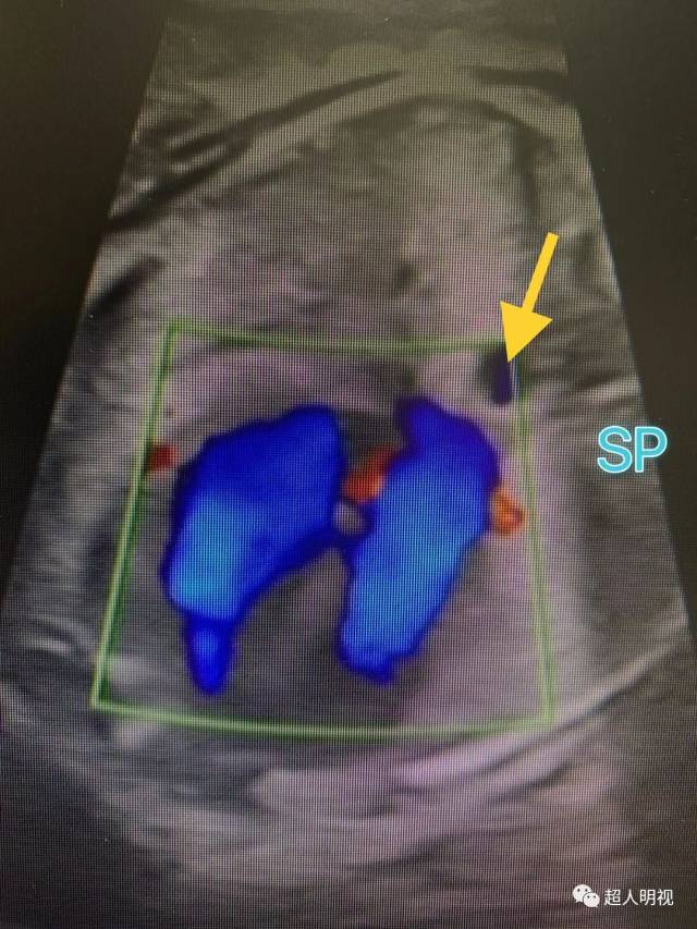 这是我每个胎儿都注意的事情,应该想到右位主动脉弓看下图