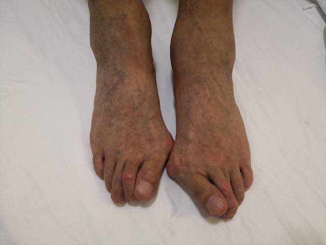 拇外翻,锤状趾,裁缝趾 (原创)