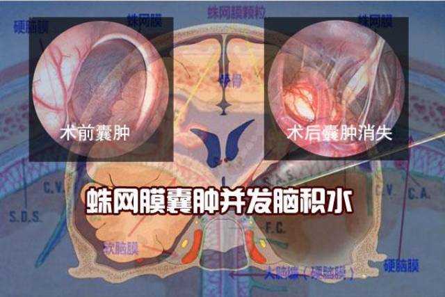 蛛网膜囊肿并发脑积水,治疗应一次性处理不宜单纯分流