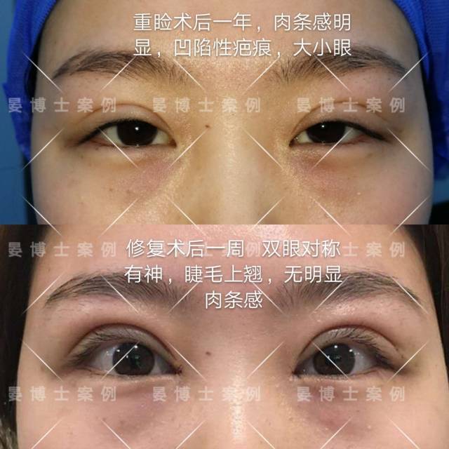 分享一例肉条感明显的重睑修复术 (原创)_手机搜狐网