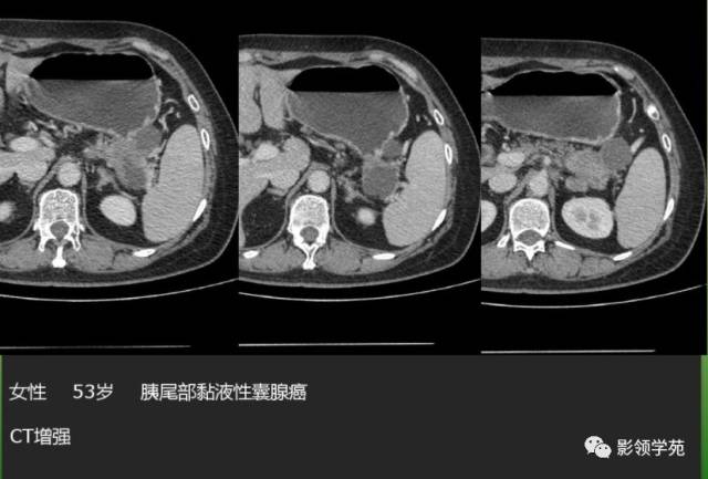 胰头部囊性灶图片