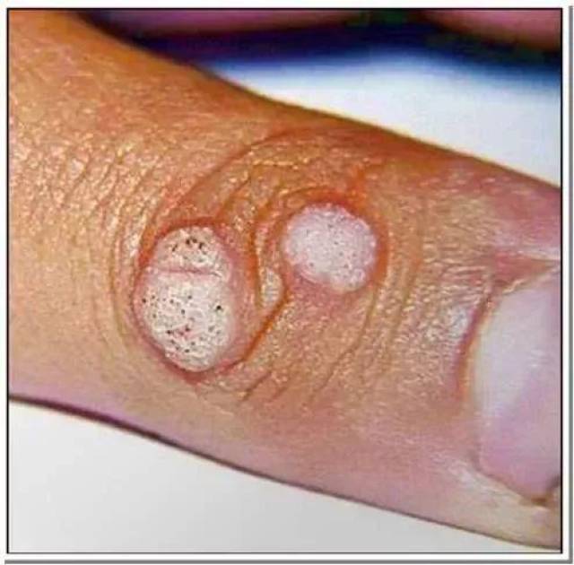 中医称"千日疮""刺瘊""瘊子"的寻常疣,是人类乳头瘤病毒(hpv)感染皮肤