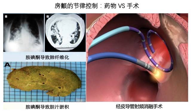 五,房颤消融手术的原理和过程是什么样子的,是否安全?