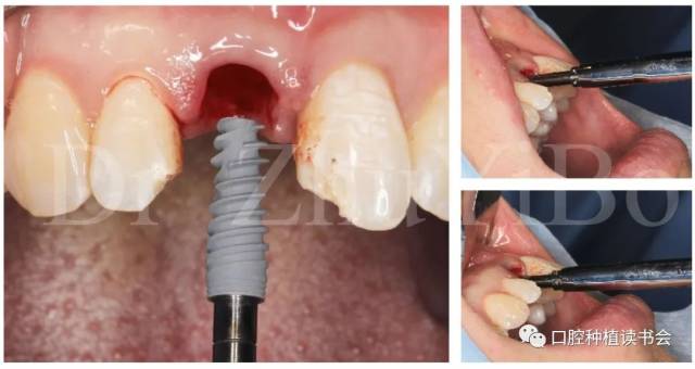 前牙即刻種植要點與案例分享|朱一博博士