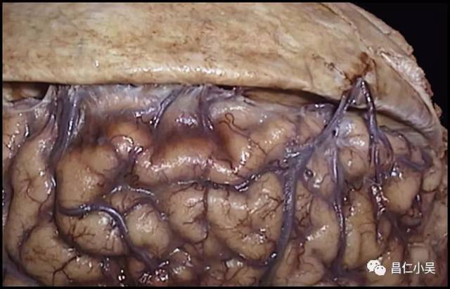 膜行于硬脑膜窦附近的硬脑膜下腔中,此段为硬脑膜下腔段(又称桥静脉)