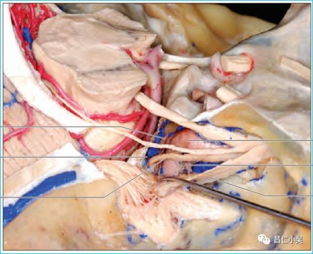 海绵窦内容物:动眼神经,滑车神经从海绵窦顶壁进入海绵窦;颈内动脉在