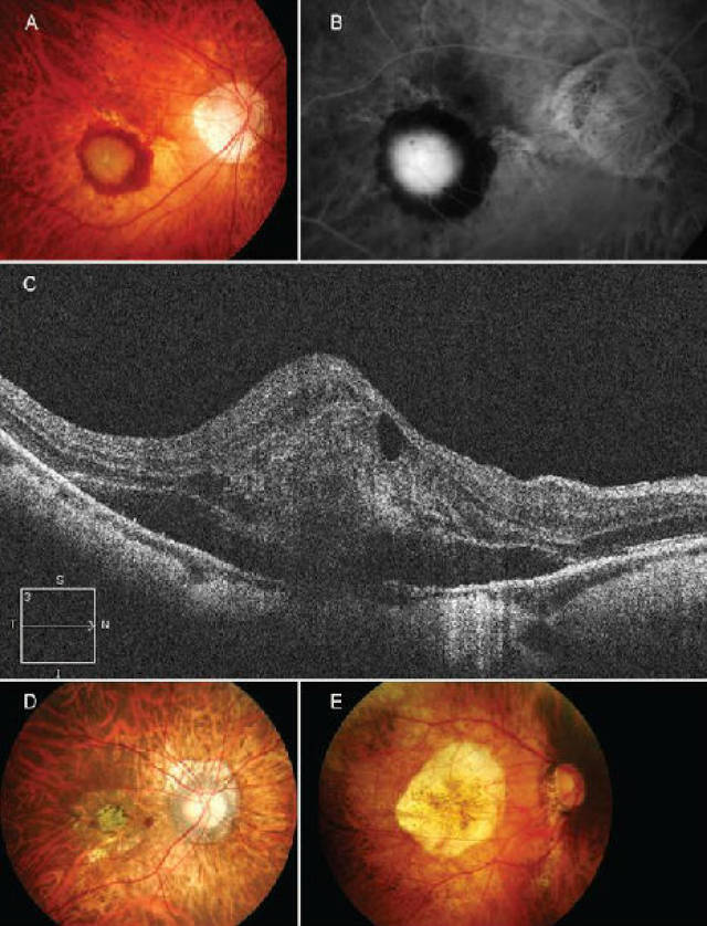 病理性近视cnv的定义及治疗的新进展总结 (转载)