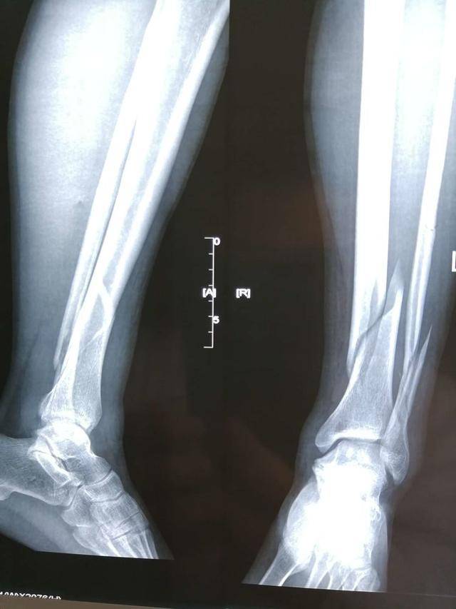 专家级髓内钉治疗胫腓骨远端骨折可以做到极致_手机搜狐网