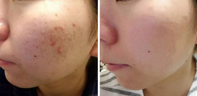 "满脸的痘痘,都被排光了"