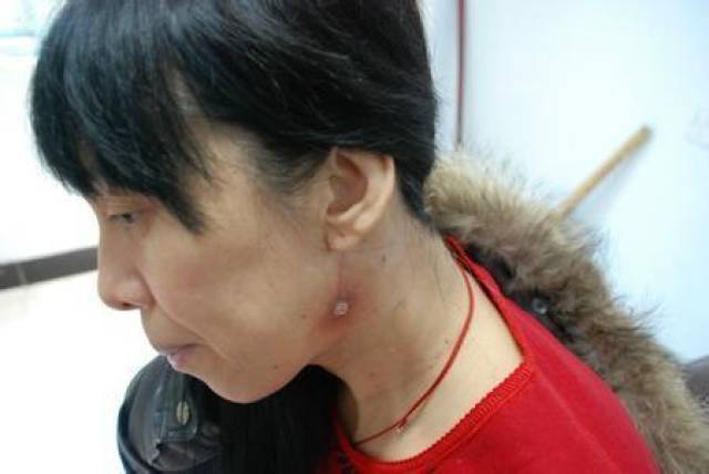 对于脖子上的淋巴肿大与淋巴结核的关系