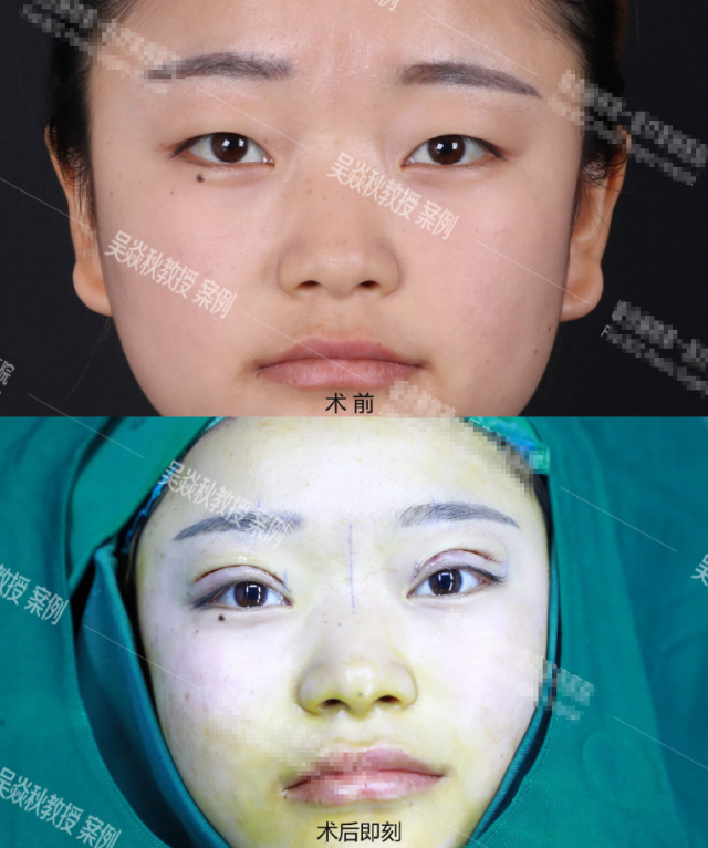 全切双眼皮 泪腺复位术3个月恢复过程全纪录 (原创)