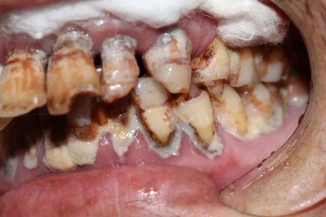 牙医碰见最烂的牙齿到底有多烂