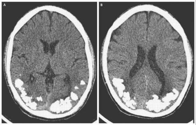 脑子里长了"结石",问题出在了肠道?医生曝光的真相让你想不到