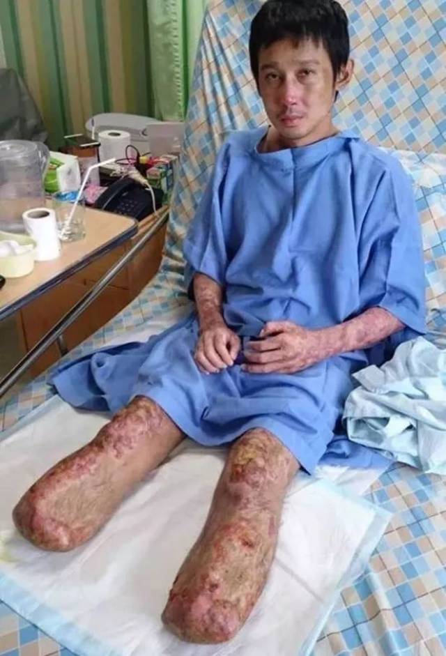 有点恐怖:吃一口猪肉,全身溃疡两脚融死