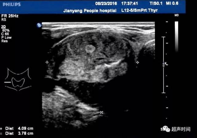 甲狀腺髓樣癌典型病例和超聲特徵
