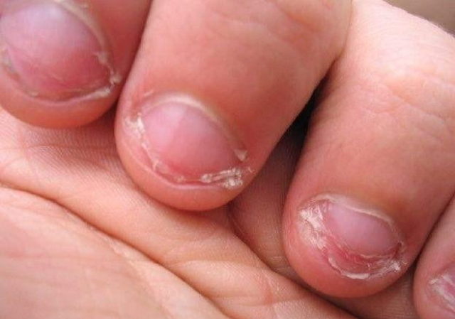 孩子总咬指甲,并非是缺维生素了,真正的原因在这里