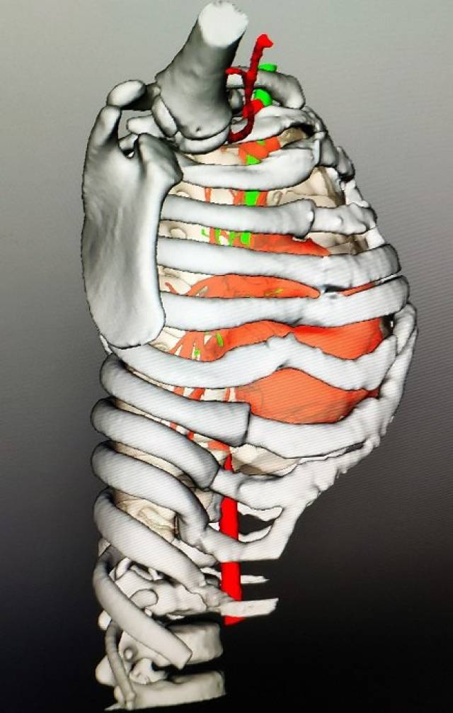胸廓变形图片