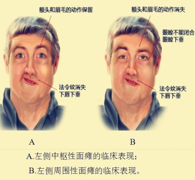 面瘫鼻唇沟,鼻唇沟肿_大山谷图库