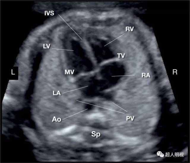 以上两张是正常胎儿四腔心,左房和降主动脉距离很近!