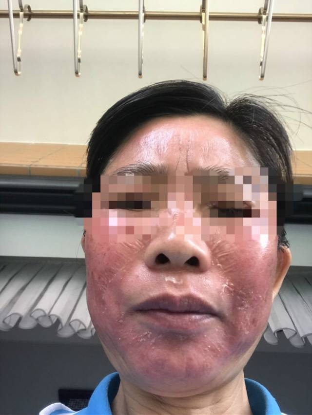 广东女子被无证美容院乱用祛斑产品,结果脸部溃烂流脓