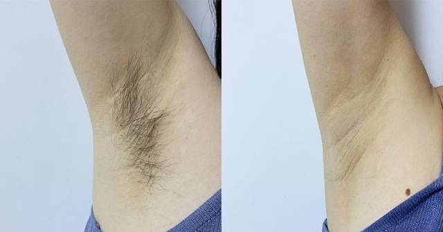 10年脱毛经验告诉你,脱毛越脱越多,越脱越粗,伤皮肤,是因为.