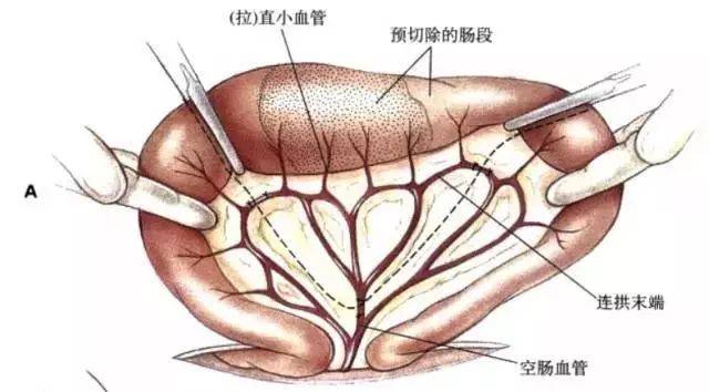 仔猪漏肠手术图片图解图片