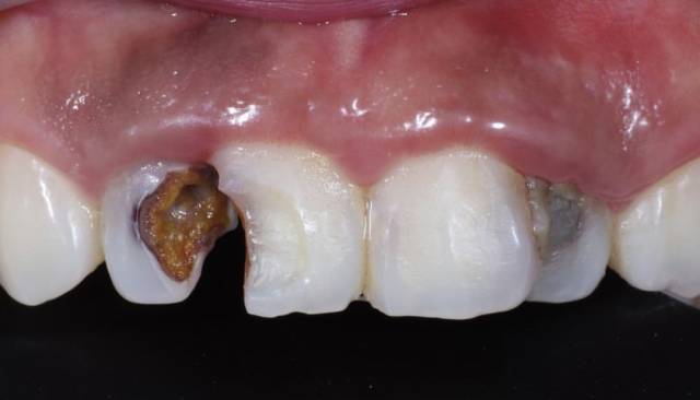 牙医遇见最烂的牙齿到底有多烂?