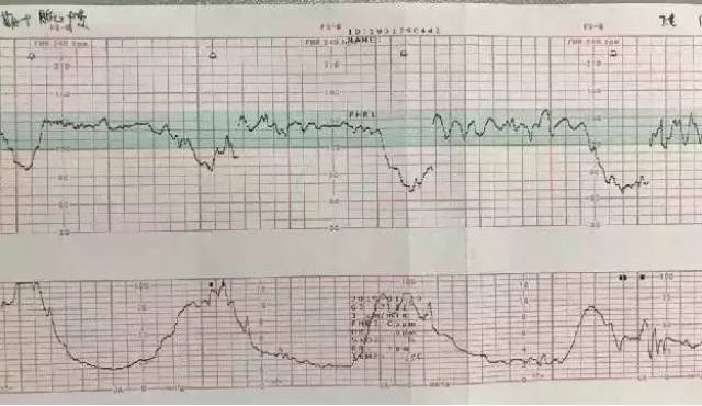 病例分享 | 在美国,剖宫产后如何成功进行阴道分娩?