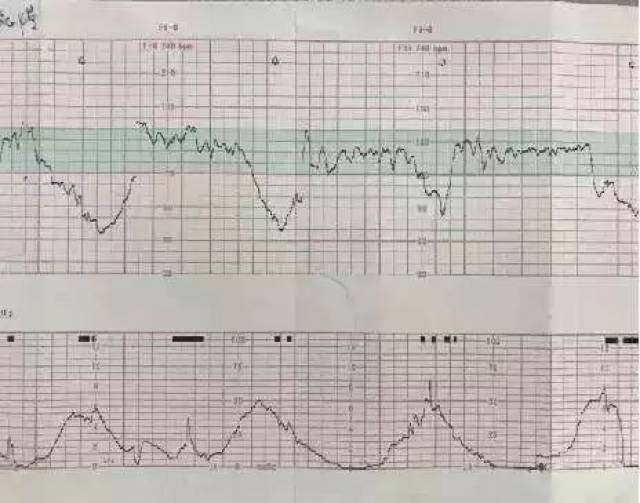 病例分享 | 在美国,剖宫产后如何成功进行阴道分娩?