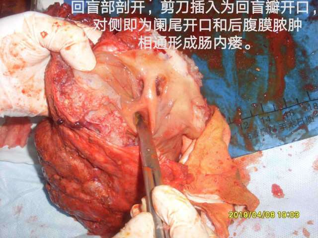 隨手術解剖右腹膜囊實性腫物與盲腸闌尾開口處形成內瘻並右腹膜後膿腫