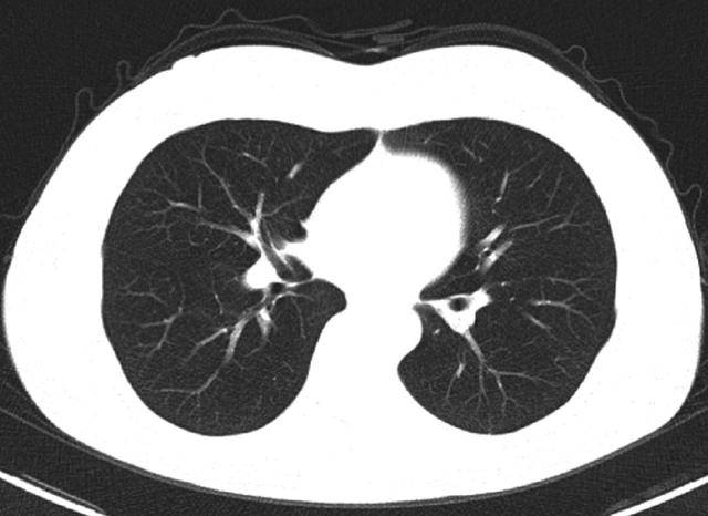 肺部ct检查结果