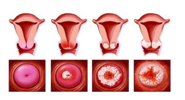 宫颈病变演变图图片