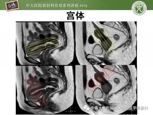 子宮影像解剖及相關mr信號分析