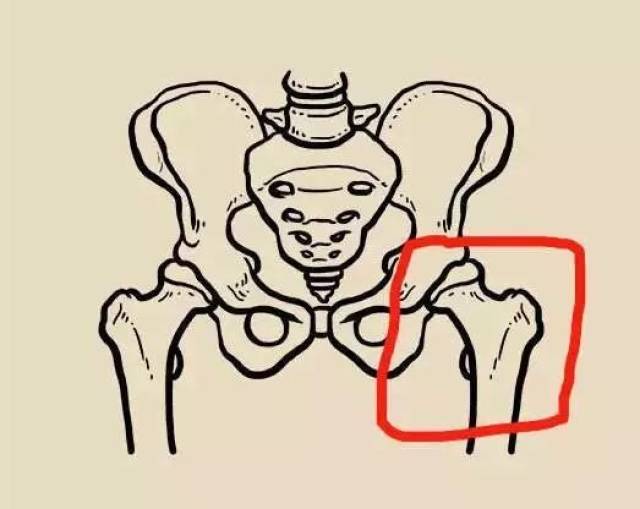 老年糖友发生股骨颈骨折的治疗