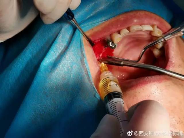 超声骨刀怎么拔牙(超声骨刀拔牙优缺点)