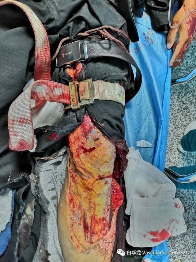 螺旋形大隐静脉移植物救治车祸休克患者断裂的下肢血管 (原创)